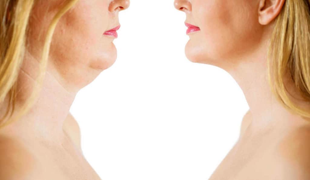 Double Chin treatment Whitley Sands before and after results