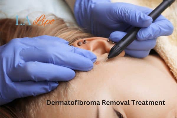 Dermatofibroma Removal Treatment Whitley Sands
