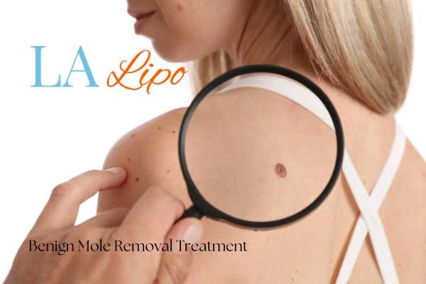 Why getting moles removed Whitley Sands can boost your confidence!