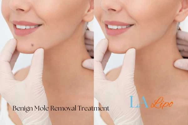 woman's before and after mole removal Whitley Sands results