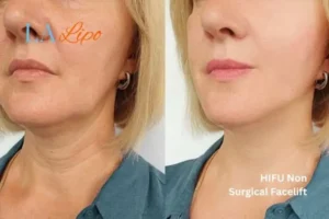hi-fu for wrinkles Whitley Sands before and after results