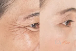 Before and after results of woman - HI-fu wrinkles reduction treatment Whitley Sands