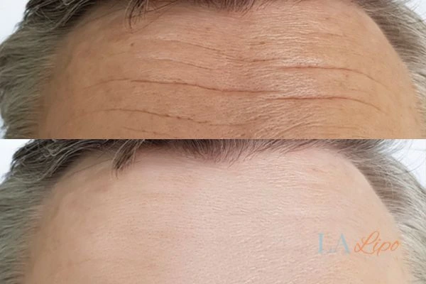results of HIFU Whitley Sands on mans forehead to help reduce lines and wrinkles