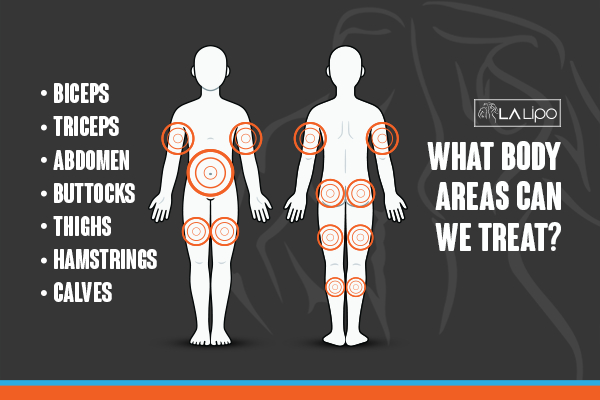 Graphic to show areas you can have LA-EMS Body Sculpting Whitley Sands treatment.