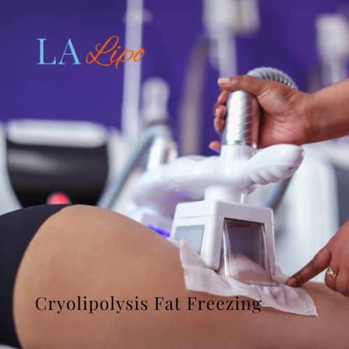 fat freezing - Cryolipolysis Whitley Sands