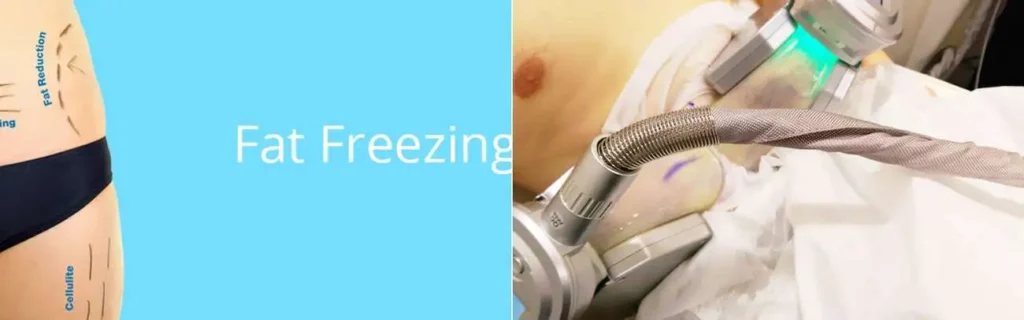 multi areas of a persons body having coolsculpting Whitley Sands treatment