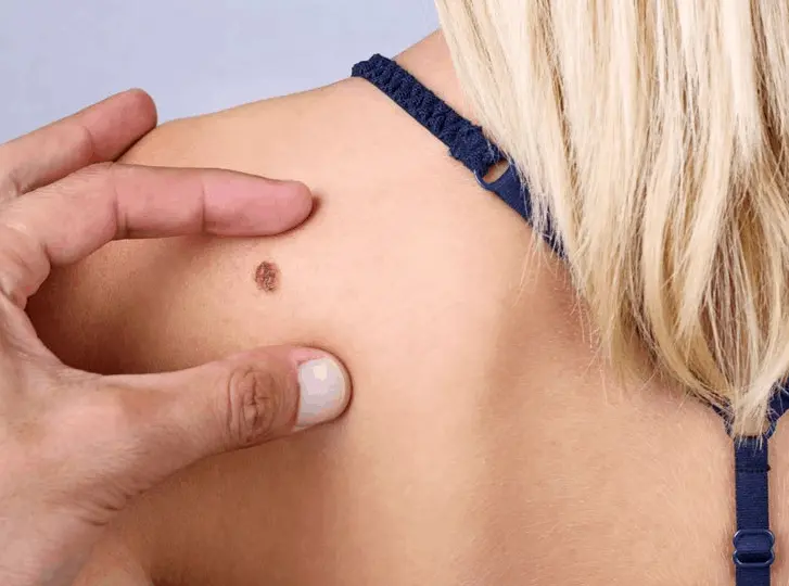 woman having mole removal Whitley Sands consultation before treatment.