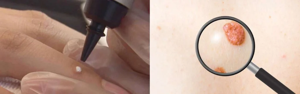 Person getting moles removed with cryopen Whitley Sands