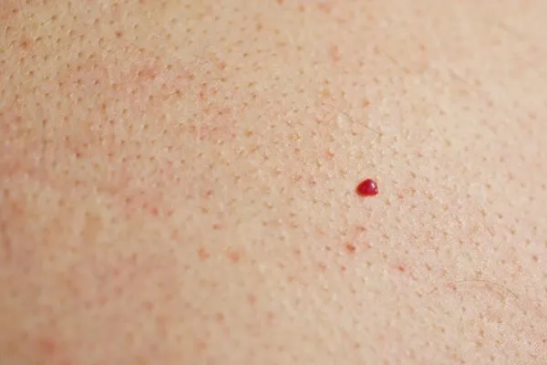 close up of a cherry angioma Whitley Sands