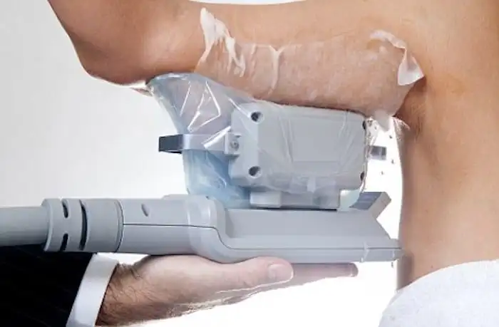 Picture of fat freezing Whitley Sands on the upper arms.
