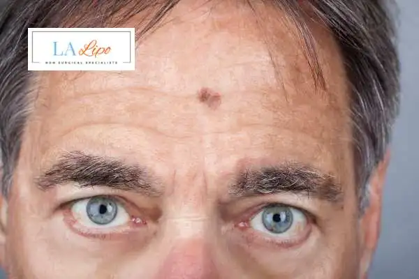 Solar Lentigo Removal Whitley Sands image of man with mark on his forehead