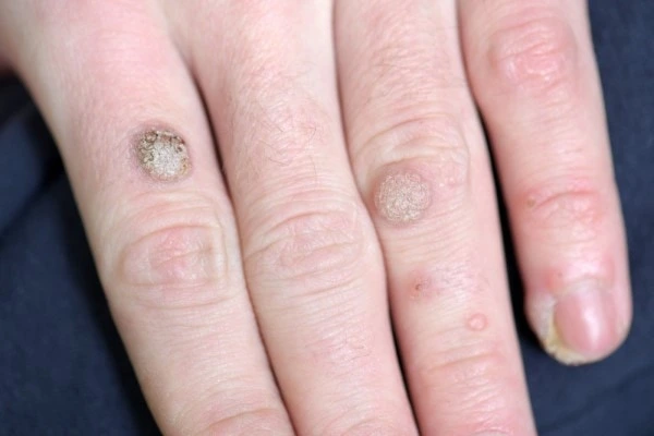 photo of warts on person hand - see wart removal Whitley Sands from LA LIPO