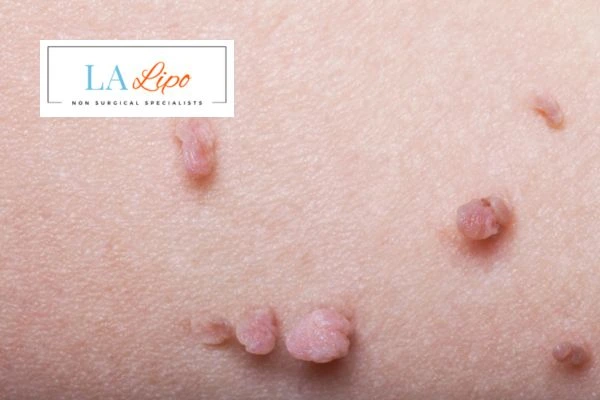 Does cryopen skin tag removal Whitley Sands hurt? Find out now call our team today!