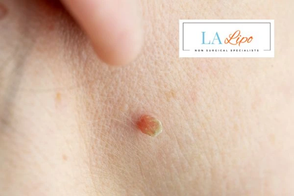 Book skin tag removal Whitley Sands today speak to our team now!