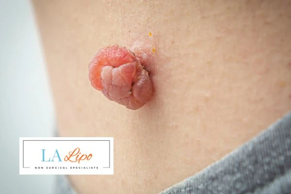 Interested in skin tag removal Whitley Sands? Concerned about the pain? Find out more today!