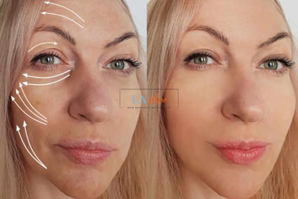 Morpheus 8 results Whitley Sands face lift.