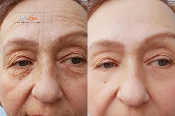 The powerful benefits of Morpheus8 Treatment Whitley Sands - Call Our team today!